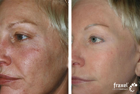 Before After Fraxel