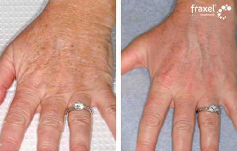 Before After Fraxel Photos