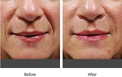 Botox Before and After Photos