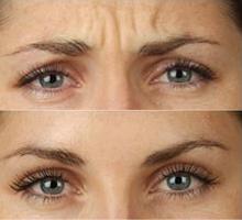 Fort Lauderdale Botox