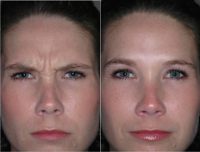 Fort Lauderdale Dysport