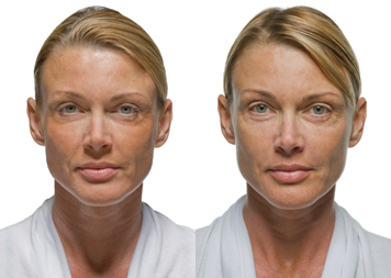 Fort Lauderdale Radiesse