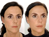 Fort Lauderdale Restylane Before and After