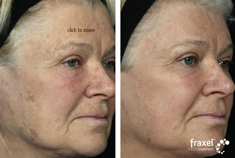 Fraxel Before and After