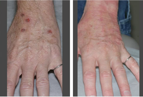 Fraxel Before and After Photos